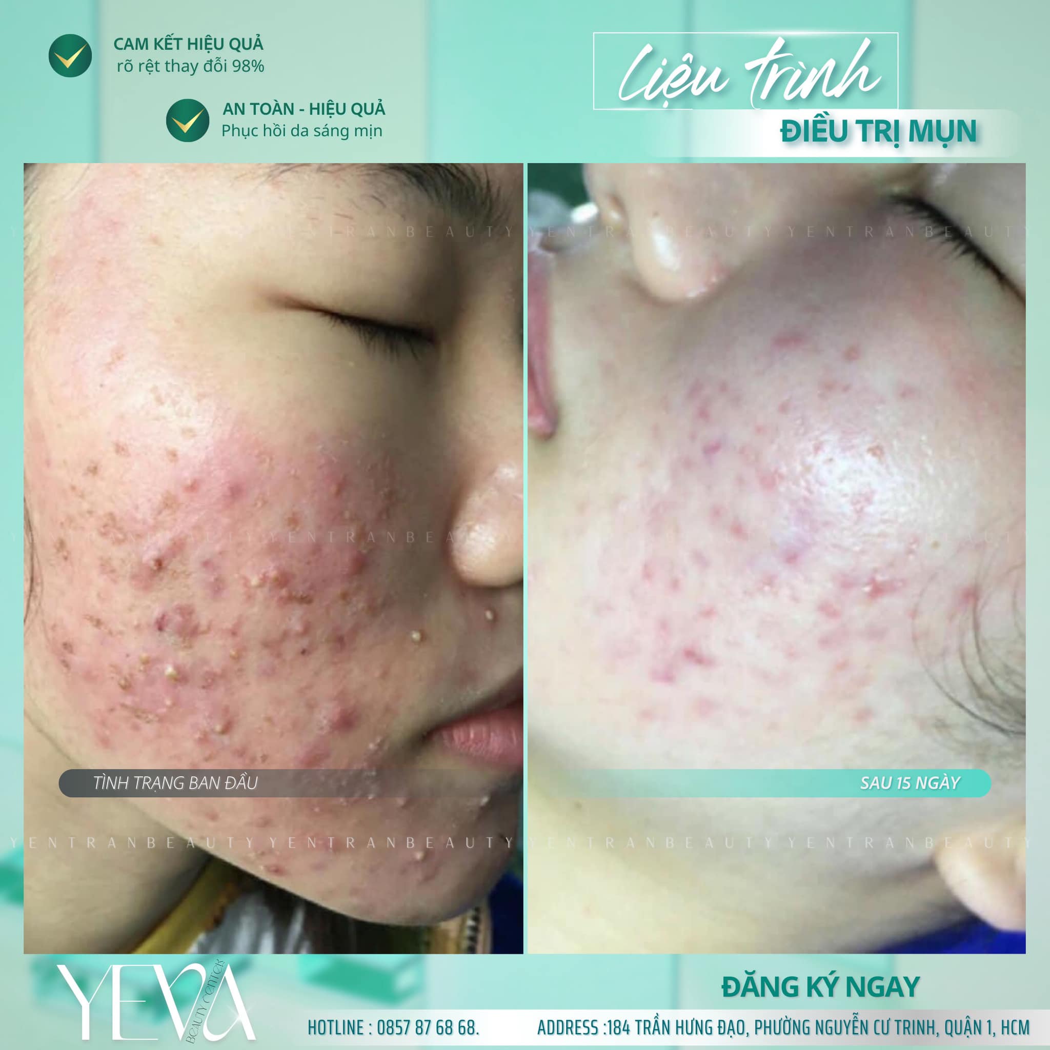 Trị Mụn