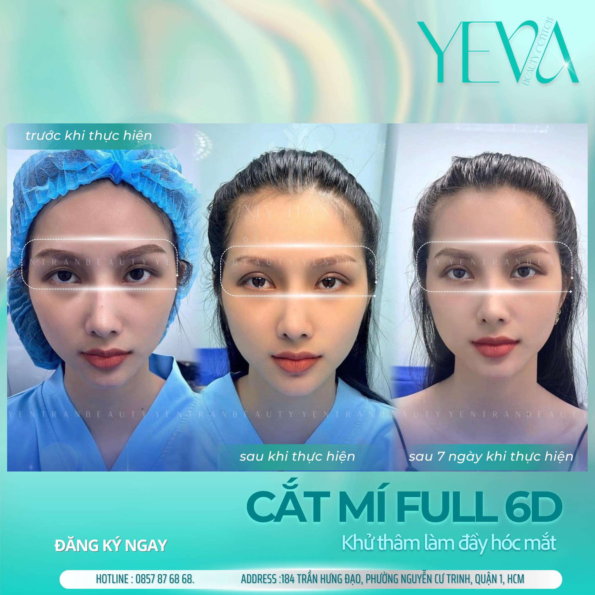 Cắt Mí Mắt